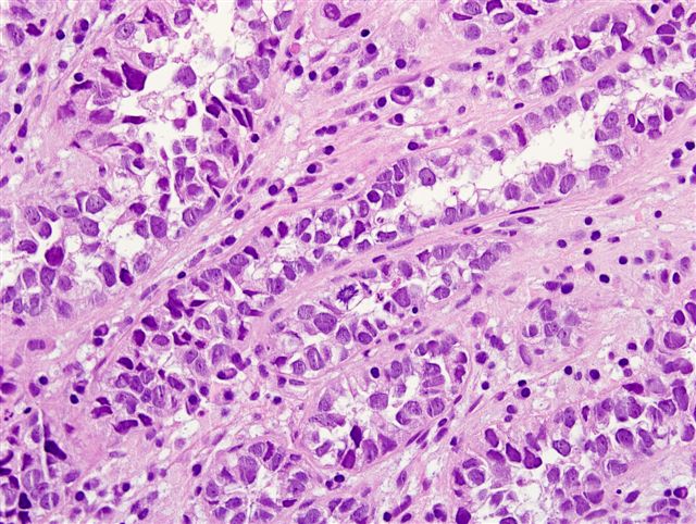 clear cell adenocarcinoma