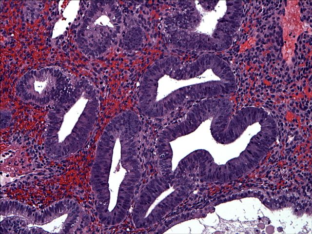 What is the treatment for disordered proliferative endometrium?