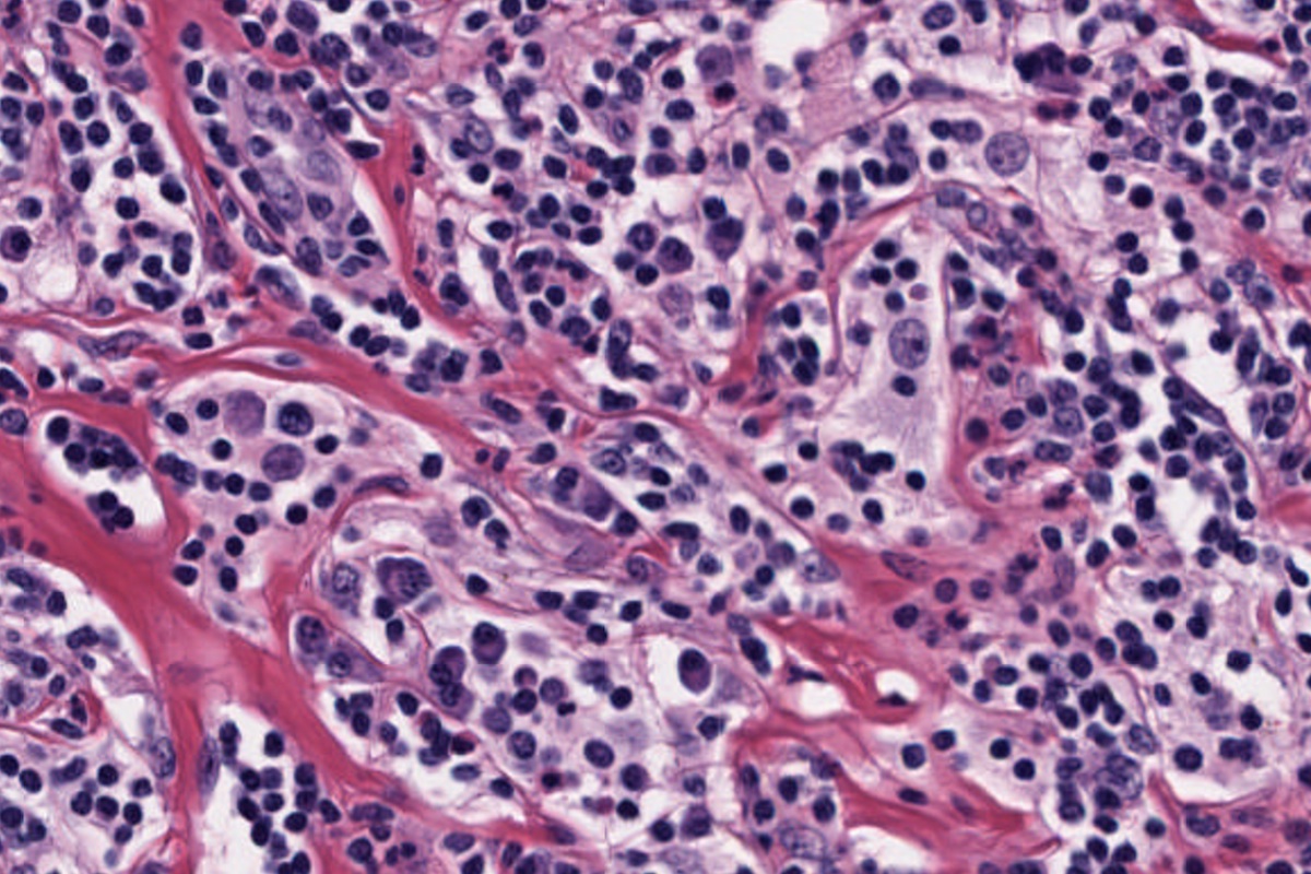Pathology Outlines Sinus Histiocytosis With Massive Lymphadenopathy
