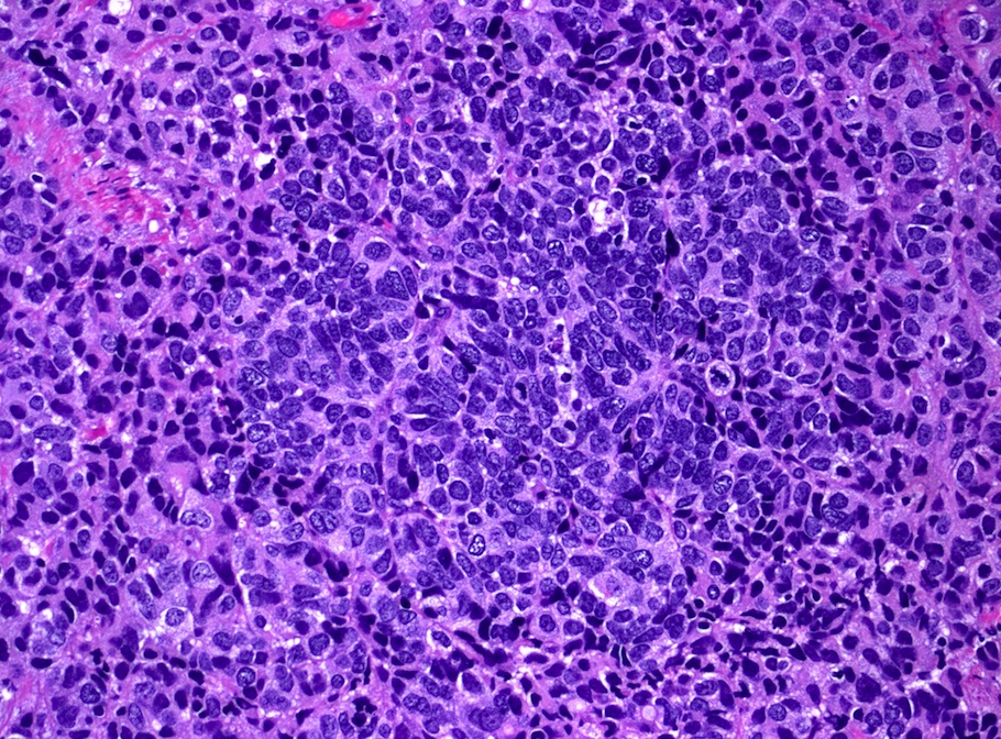 Large cell carcinoma lung histopathology report