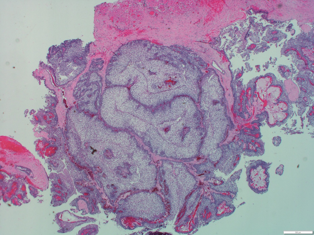 Pathology Outlines - Mucoepidermoid carcinoma