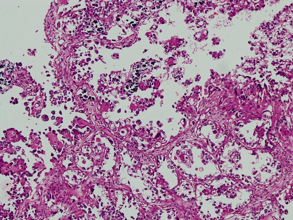 cell Vaginal carcinoma clear