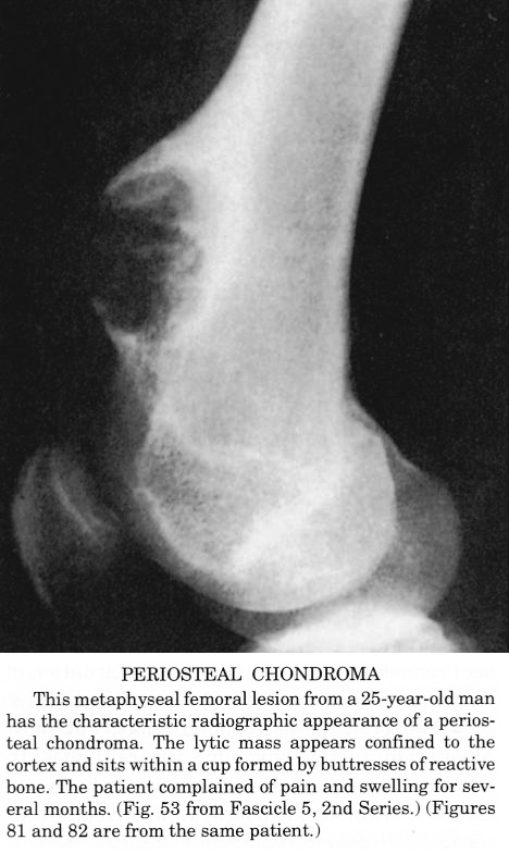 Pathology Outlines - Juxtacortical (periosteal) chondroma