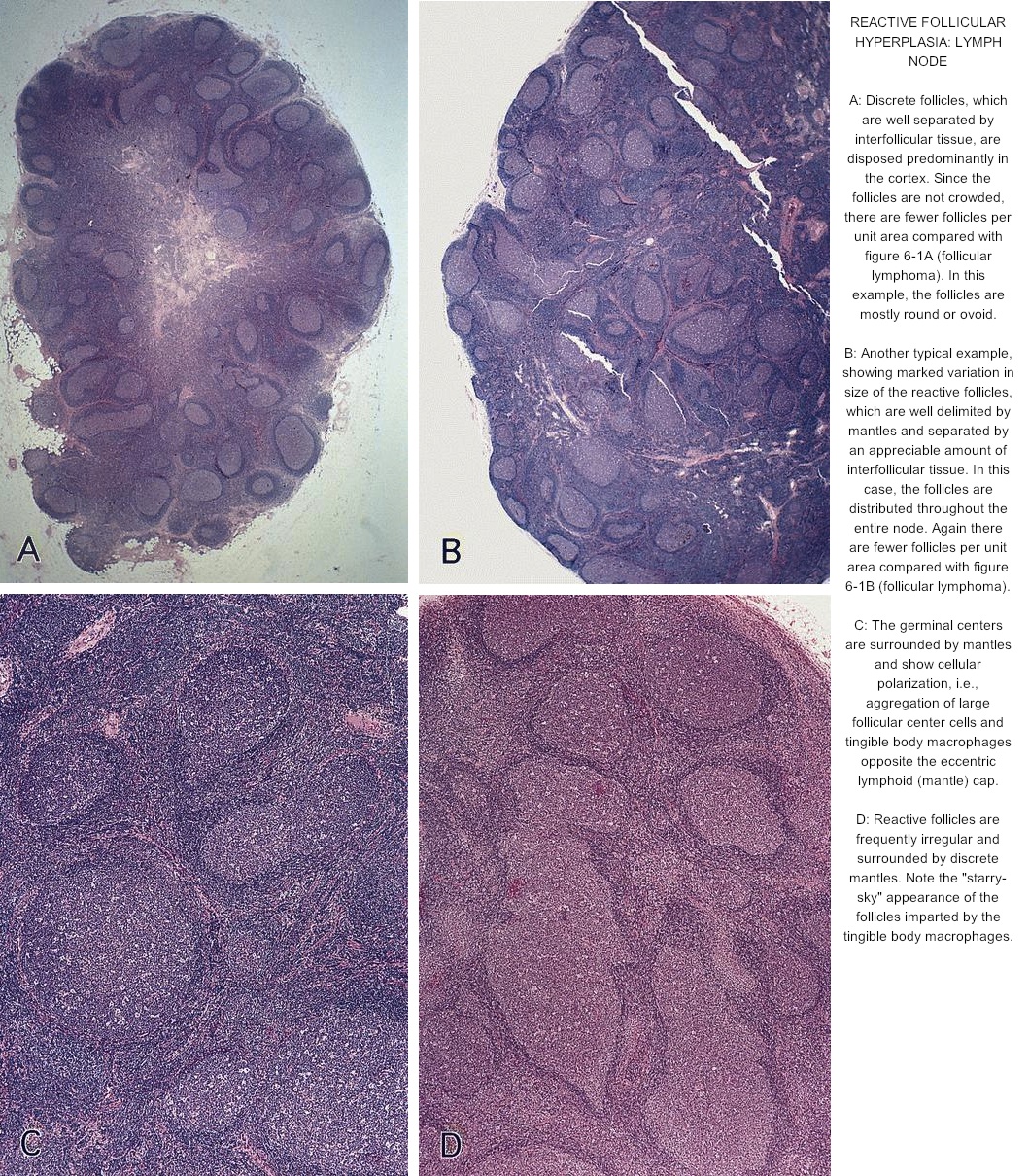 Pathology Outlines - Follicular hyperplasia

