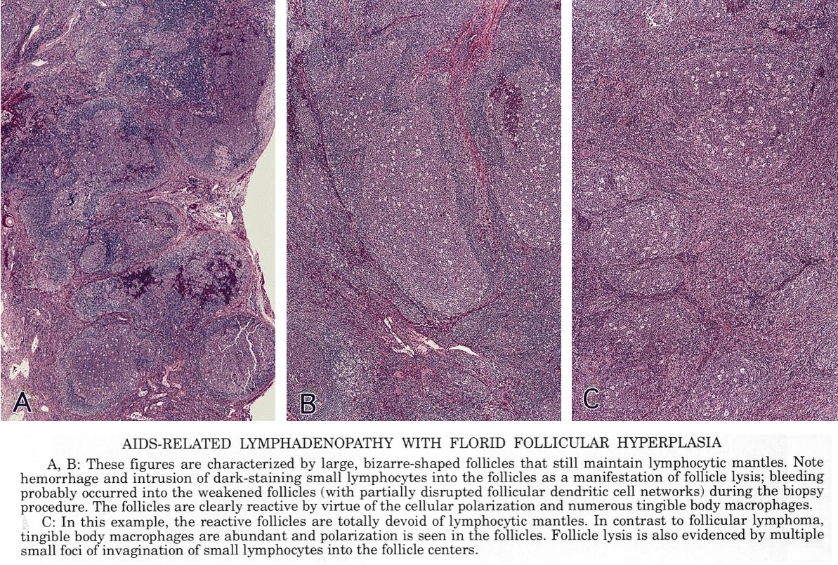 Pathology Outlines Follicular hyperplasia