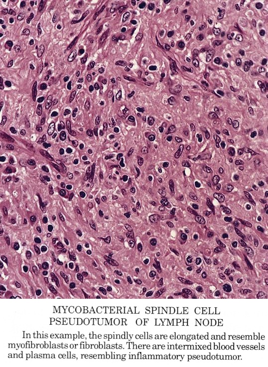 Pathology Outlines Mycobacterial spindle cell pseudotumor