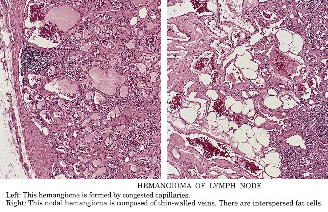 Pathology Outlines - Hemangioma