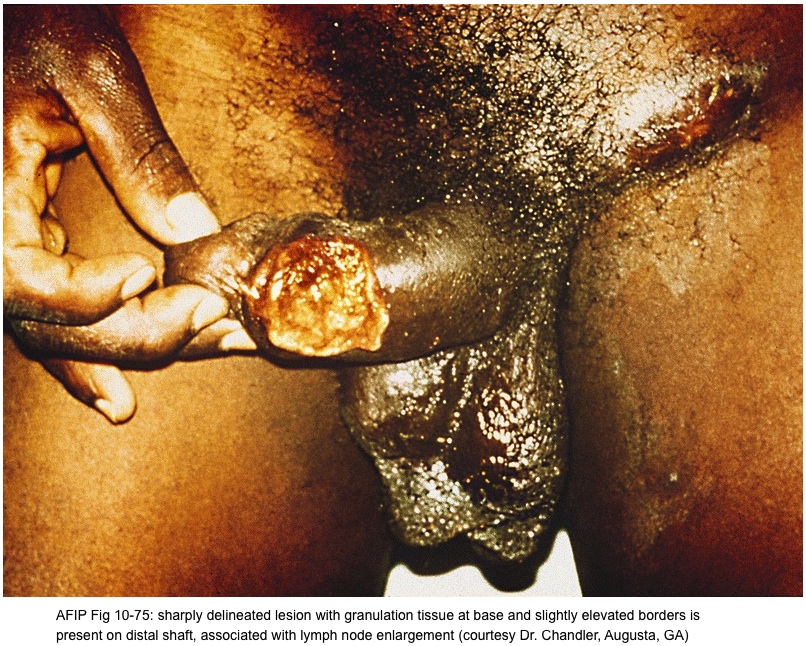 Penis and scrotum - Herpes simplex virus (HSV)