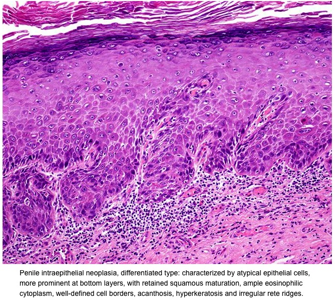 Note the flat surface with abrupt parakeratosis PENILE INTRAEPITHELIAL 
