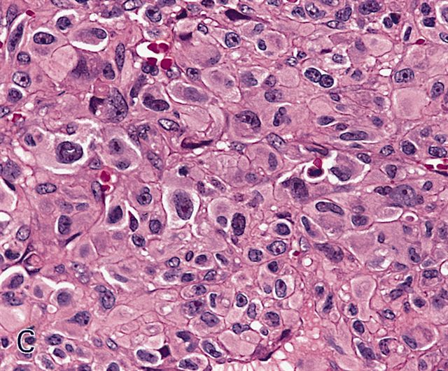 Pathology Outlines - Pleomorphic rhabdomyosarcoma