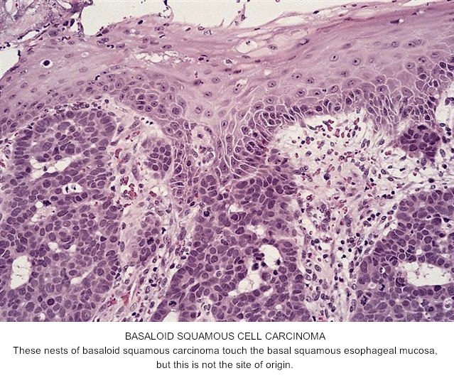 Pathology Outlines - Basaloid squamous cell carcinoma