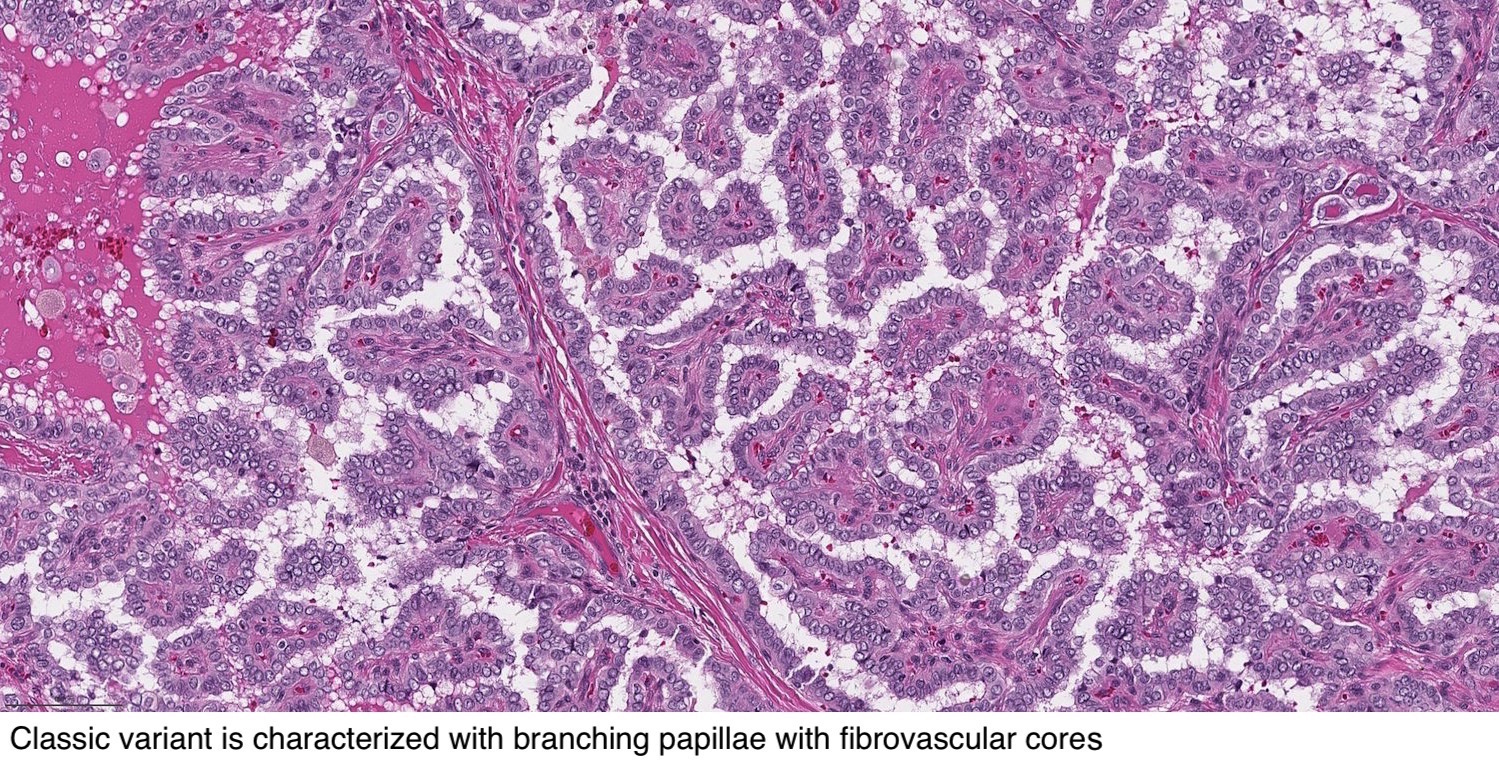 Pathology Outlines Papillary thyroid carcinoma classic