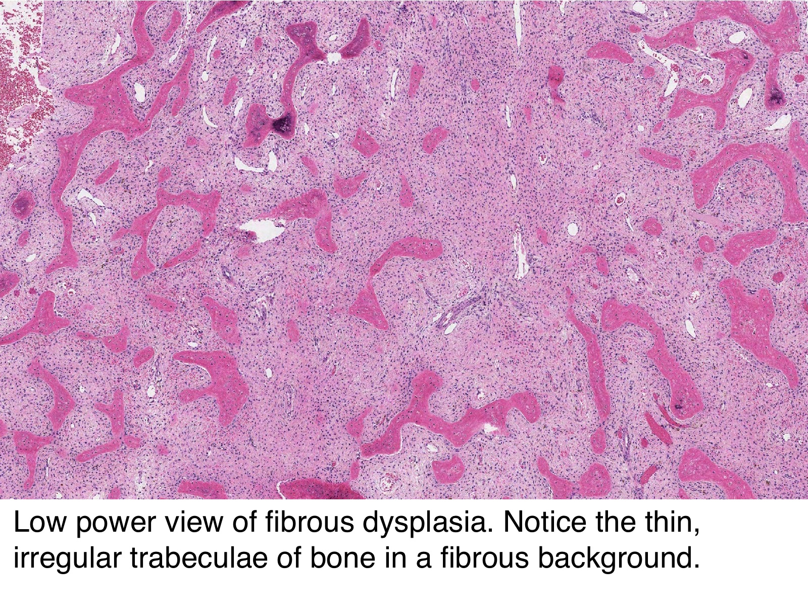 Pathology Outlines Fibrous dysplasia