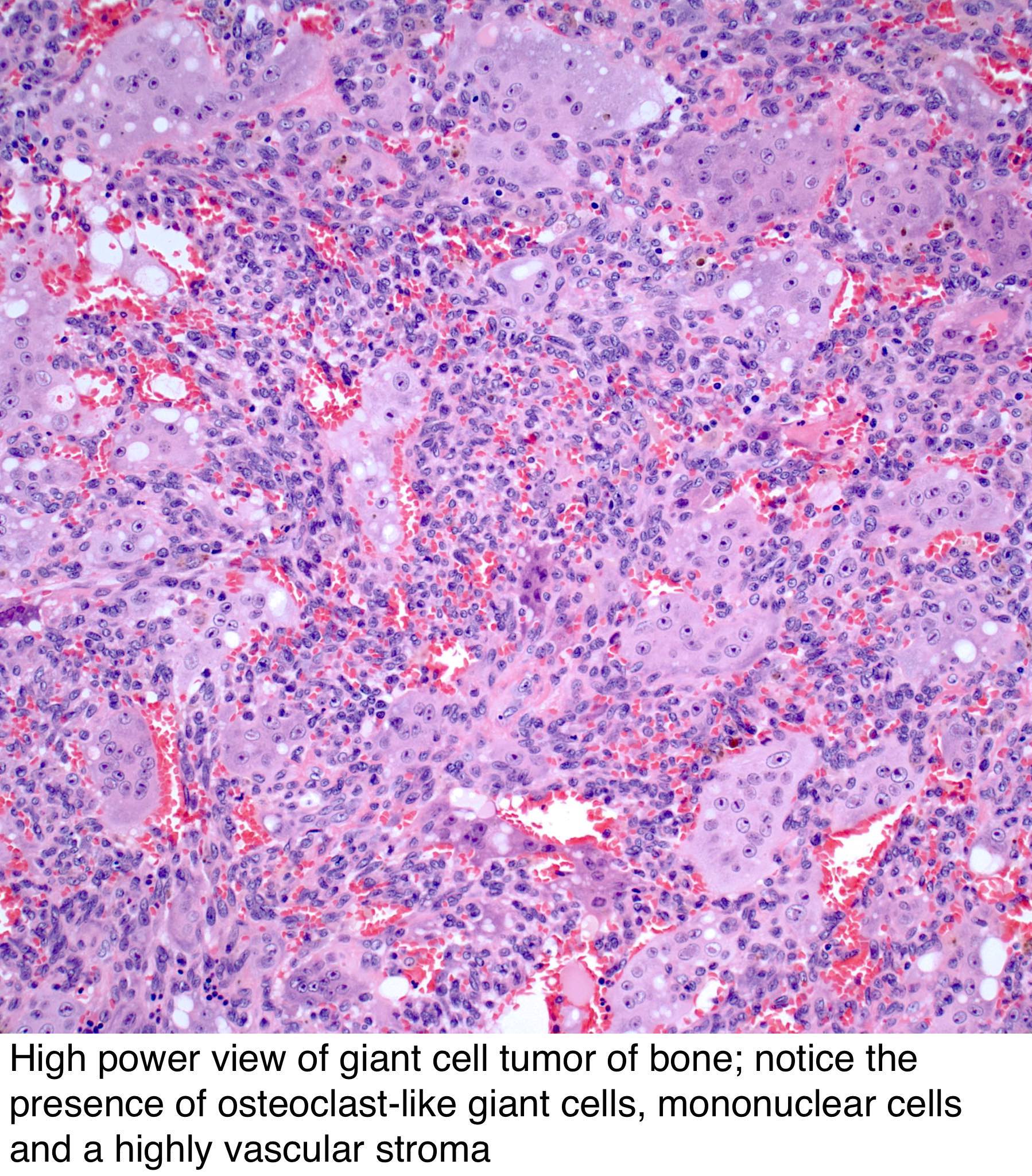 Pathology Outlines Giant Cell Tumor Of Bone