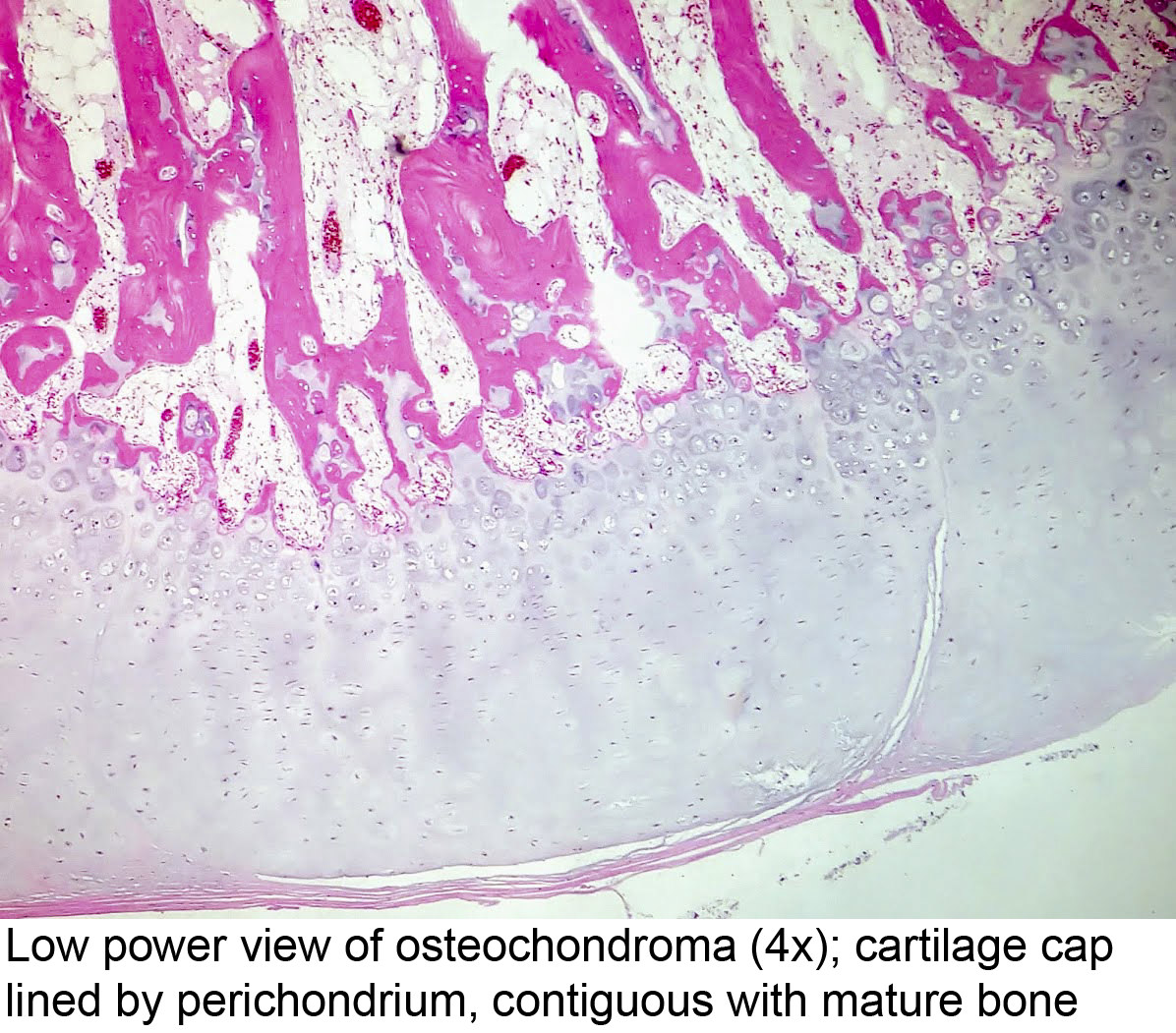 Pathology Outlines - Osteochondroma