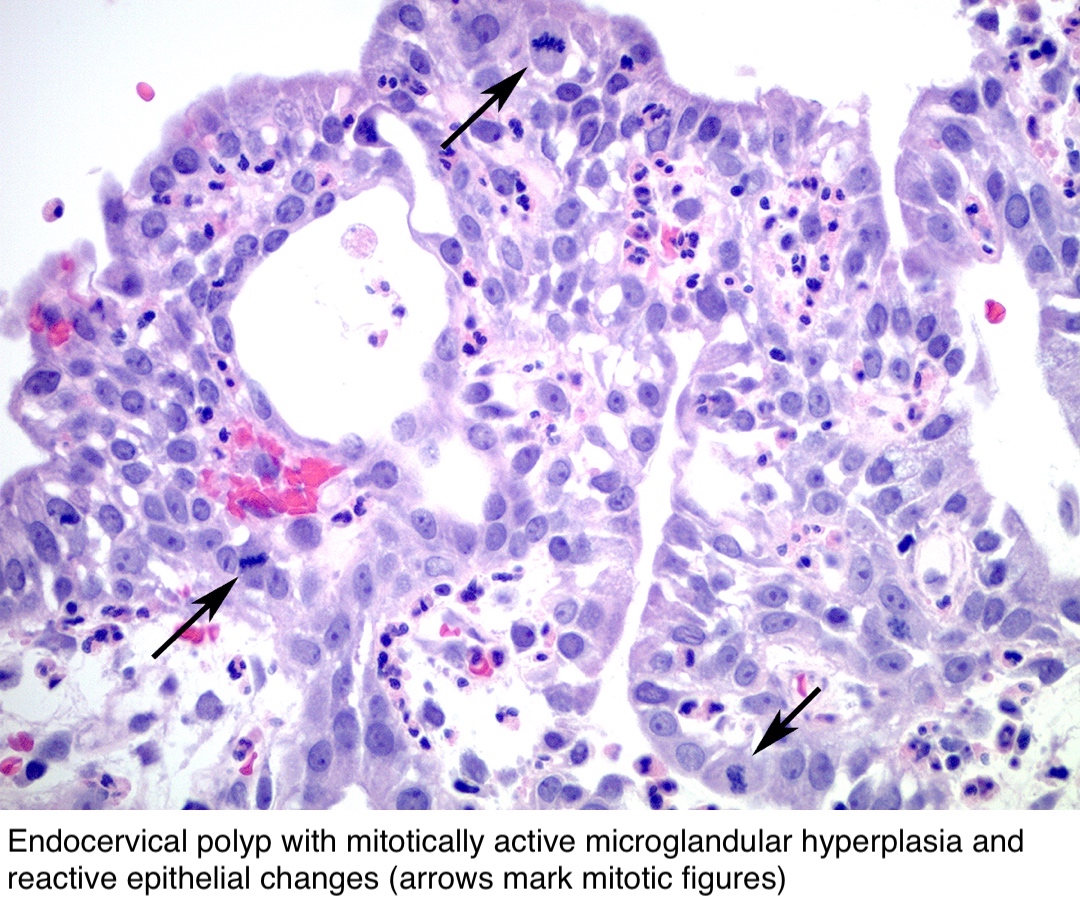 Pathology Outlines - Endocervical polyp