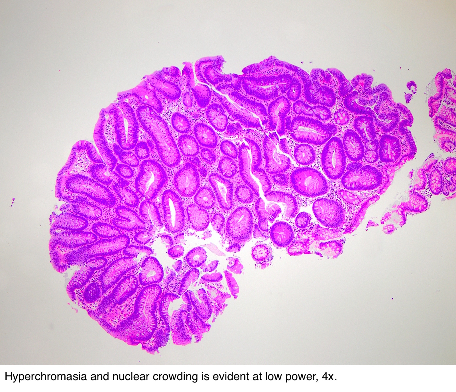 Pathology Outlines - Tubulovillous / villous adenoma