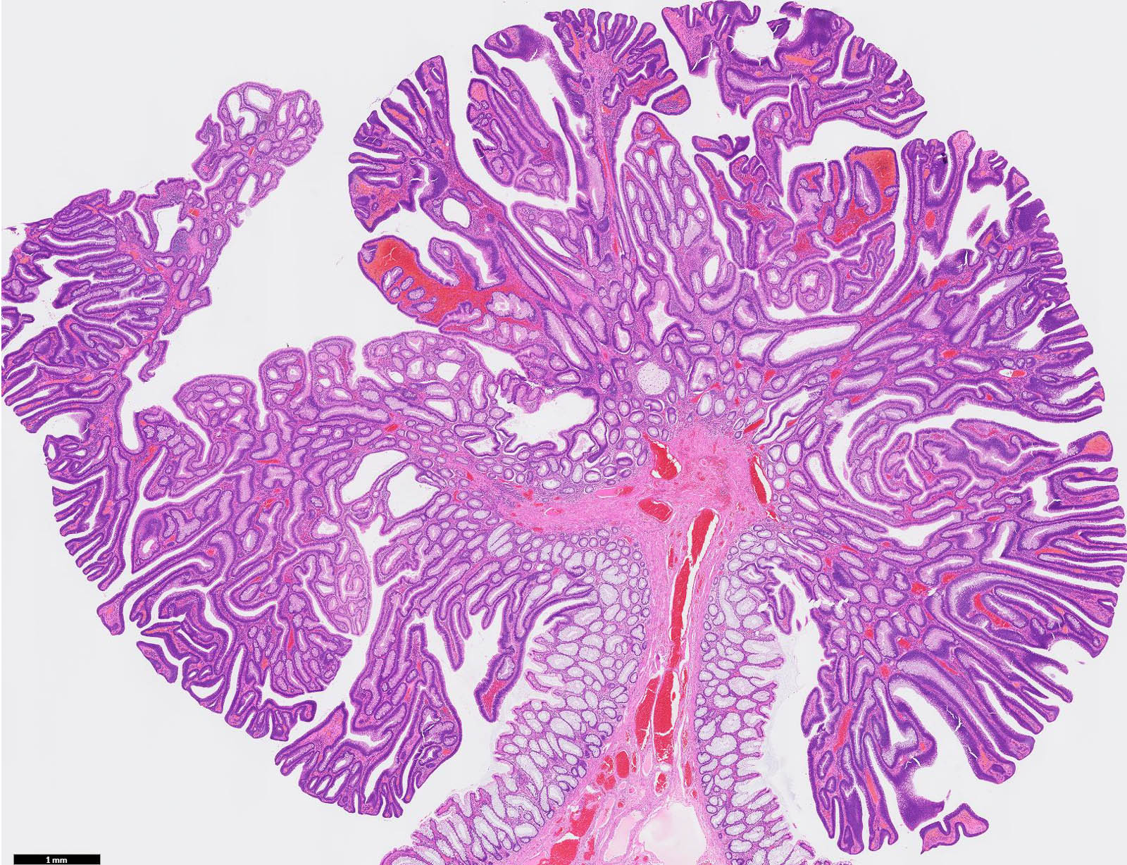 Pathology Outlines - Tubular adenoma