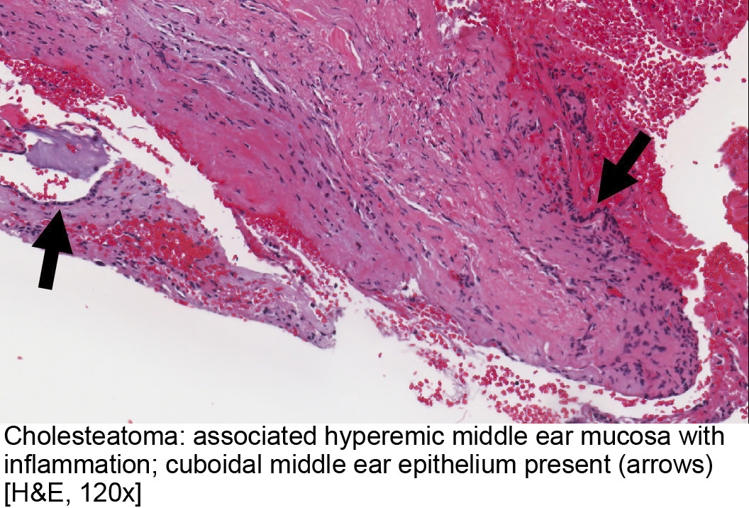 Pathology Outlines Cholesteatoma
