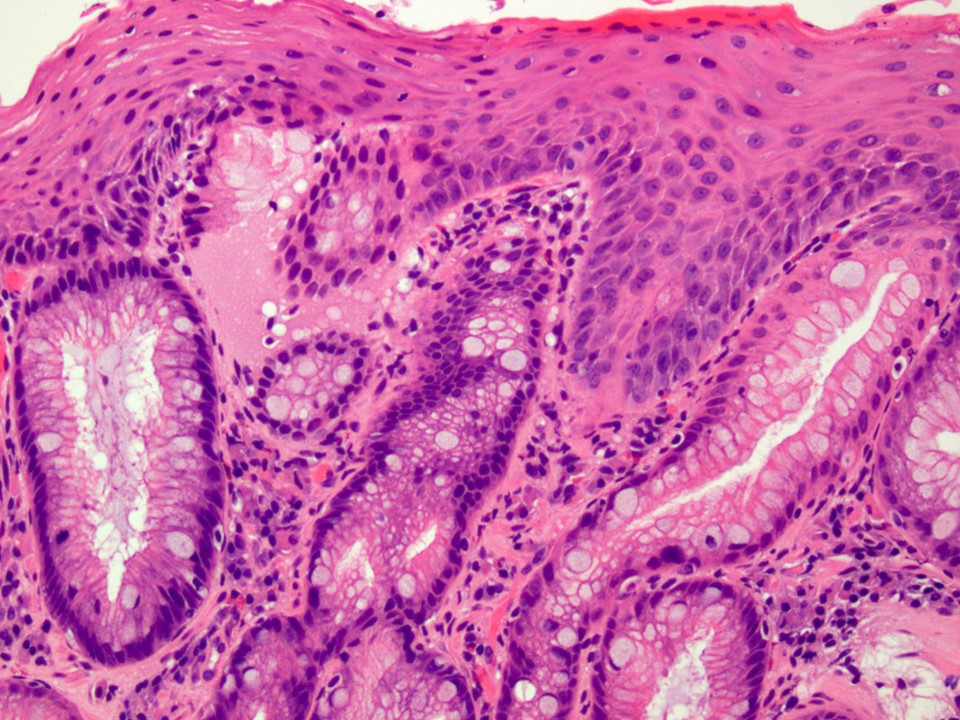 Pathology Outlines - Barrett esophagus (BE)