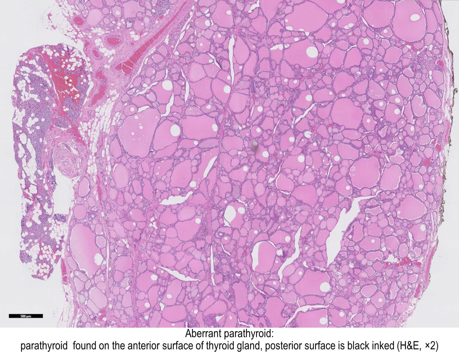 pathology outlines - ectopic parathyroid tissue