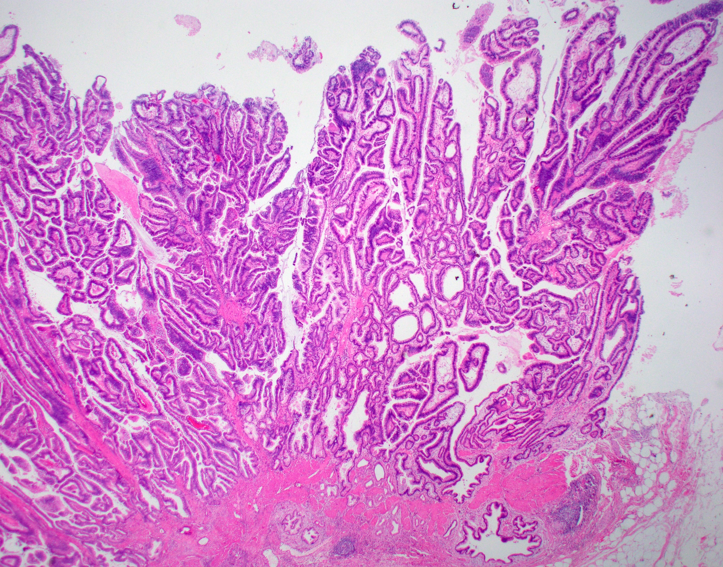 Pathology Outlines - Gallbladder carcinoma