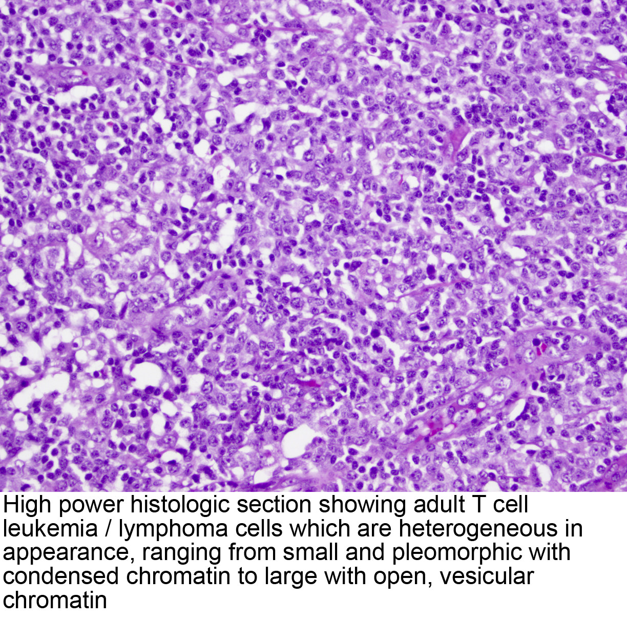 Pathology Outlines - ATLL