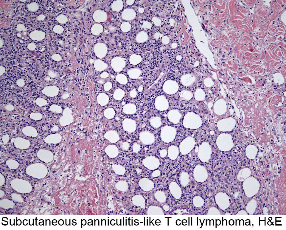 Lymph Node - Large Cell Lymphoma - NUS Pathweb