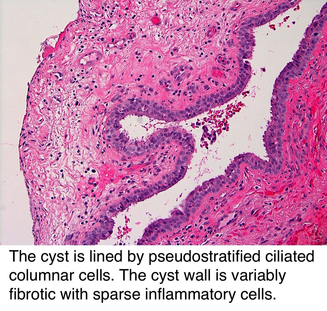 Pathology Outlines - Surgical ciliated cyst