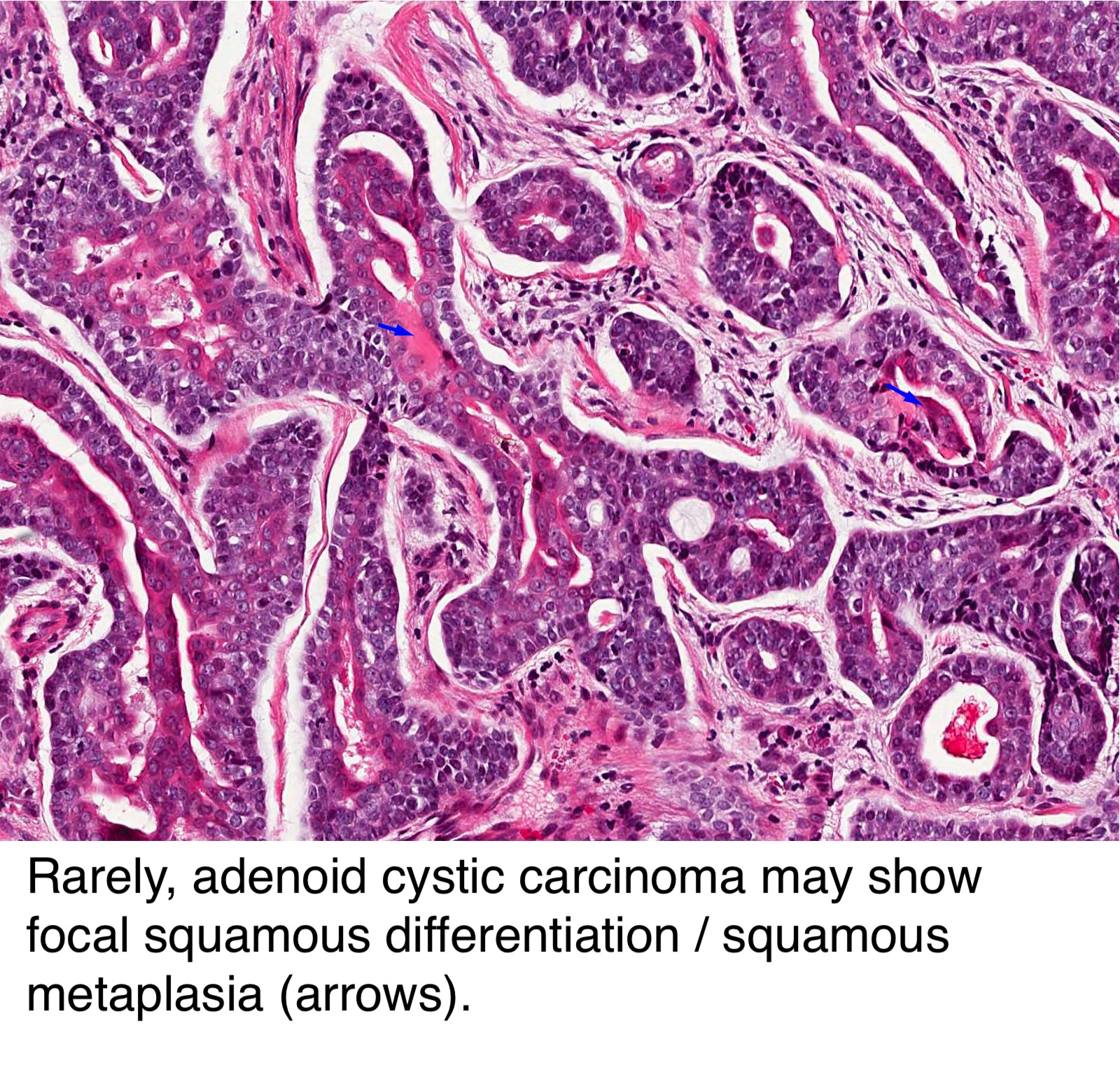Pathology Outlines Adenoid Cystic Carcinoma