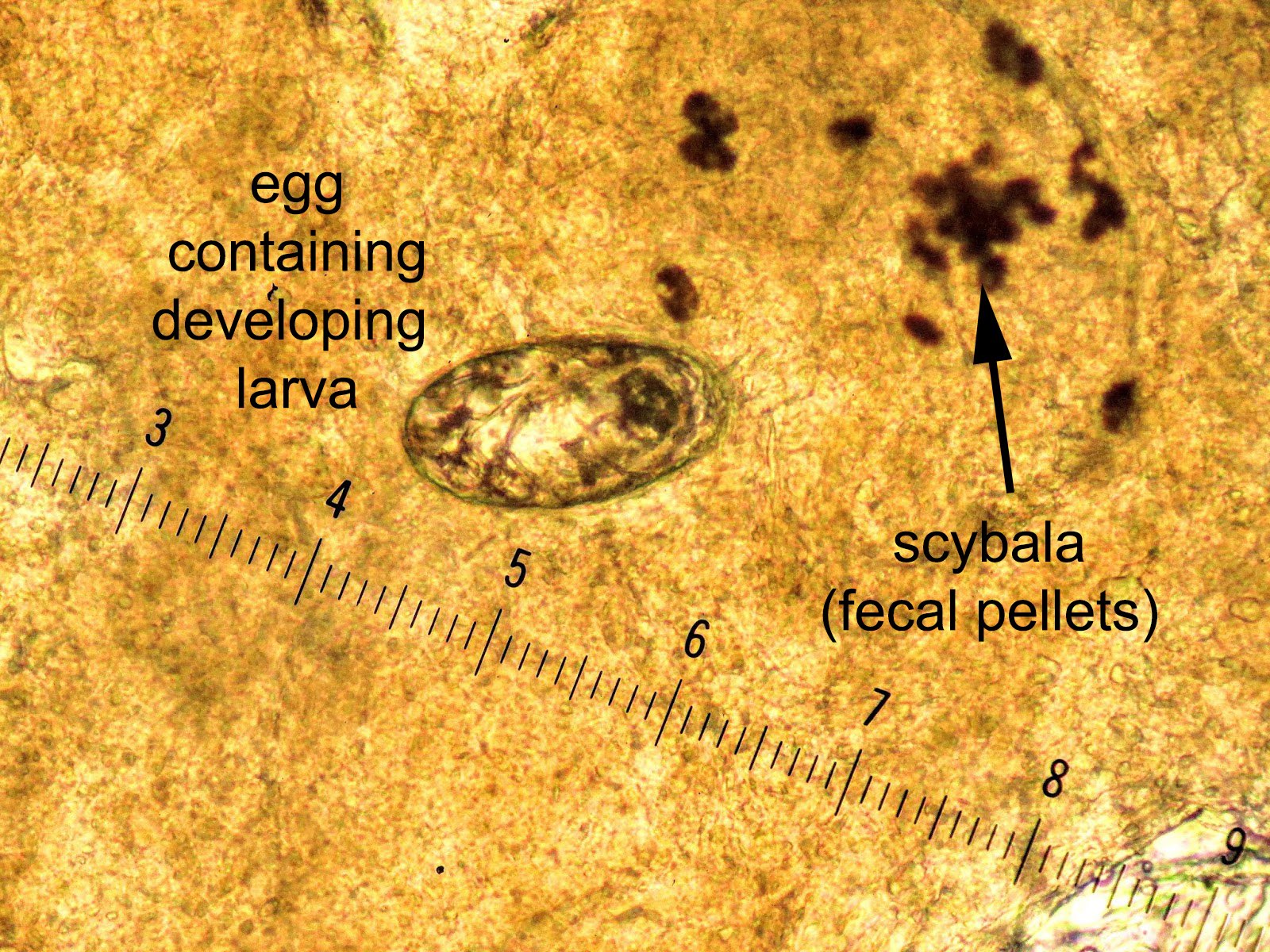 Pathology Outlines Scabies Mite