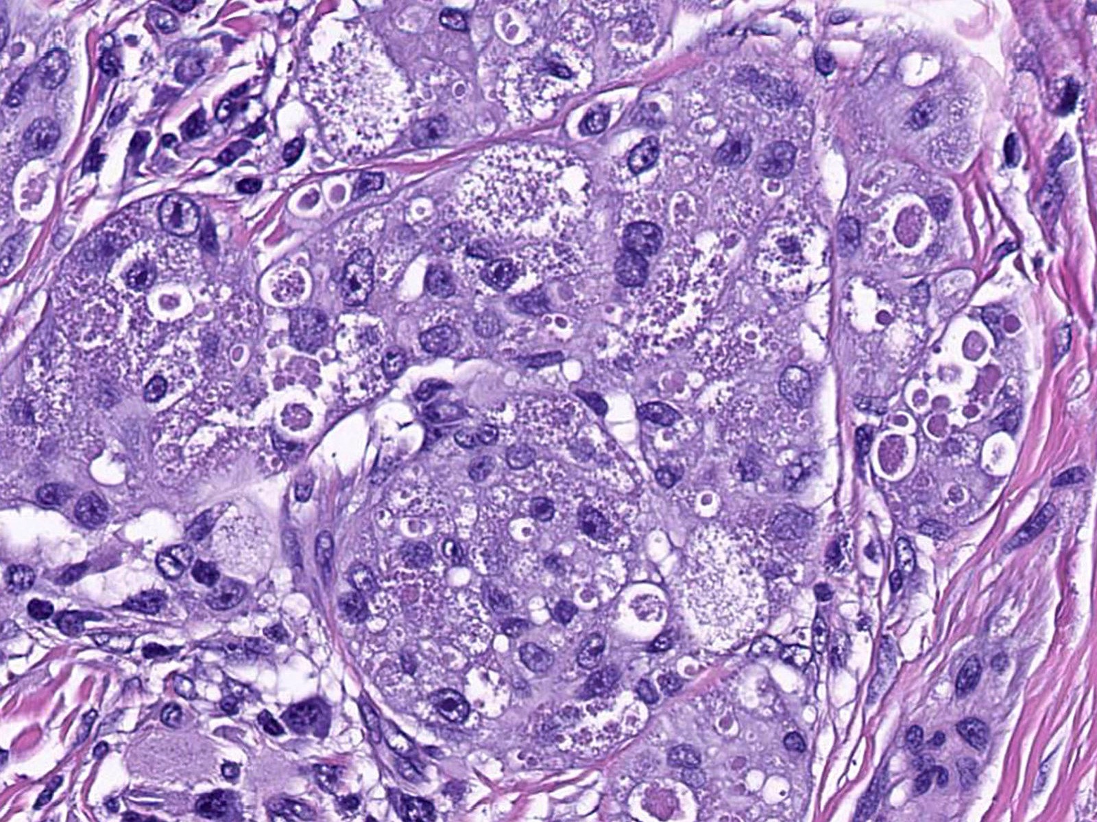 Pathology Outlines - Granular cell tumor