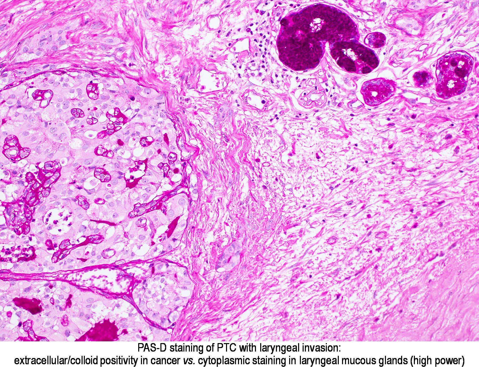 Image result for PAS staining