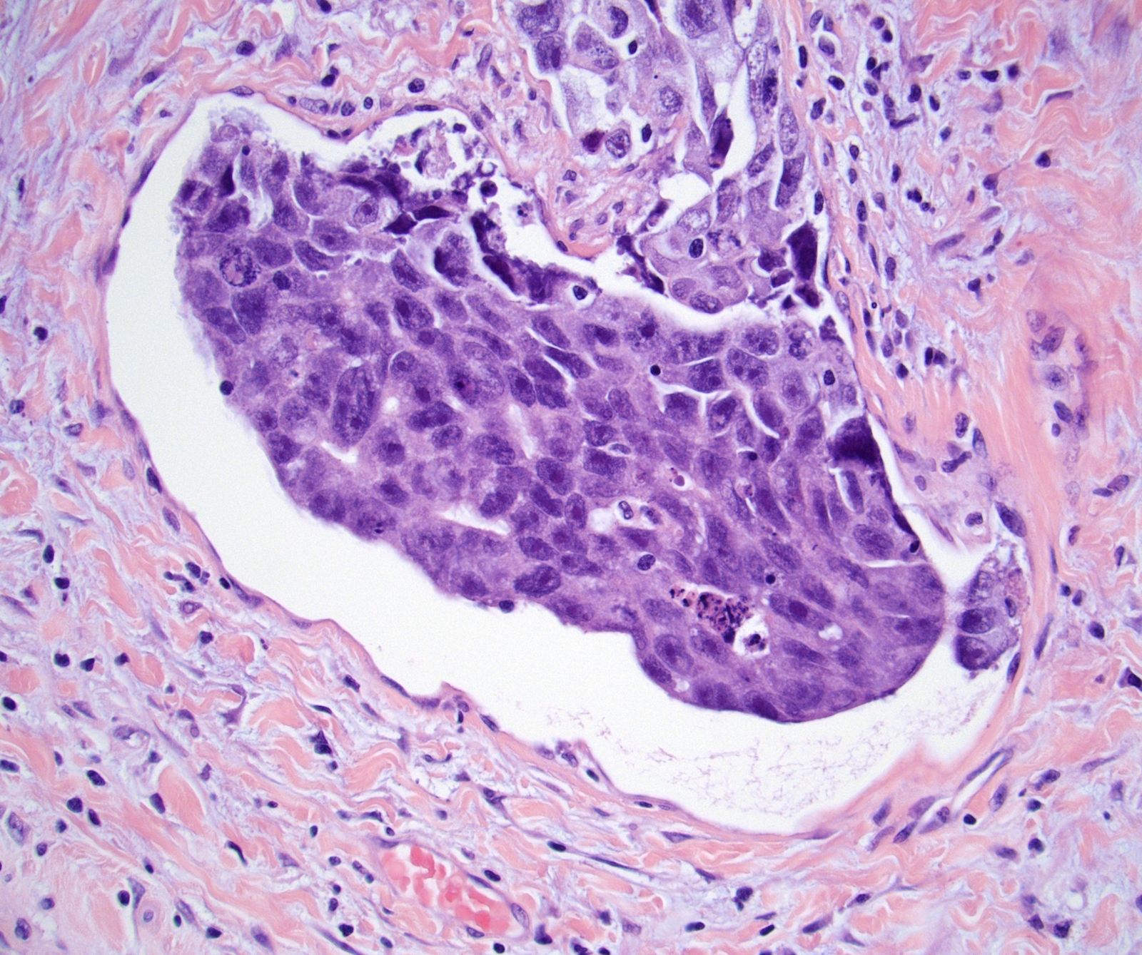 Pathology Outlines Pathologic Tnm Staging Of Testis Germ Cell Tumor