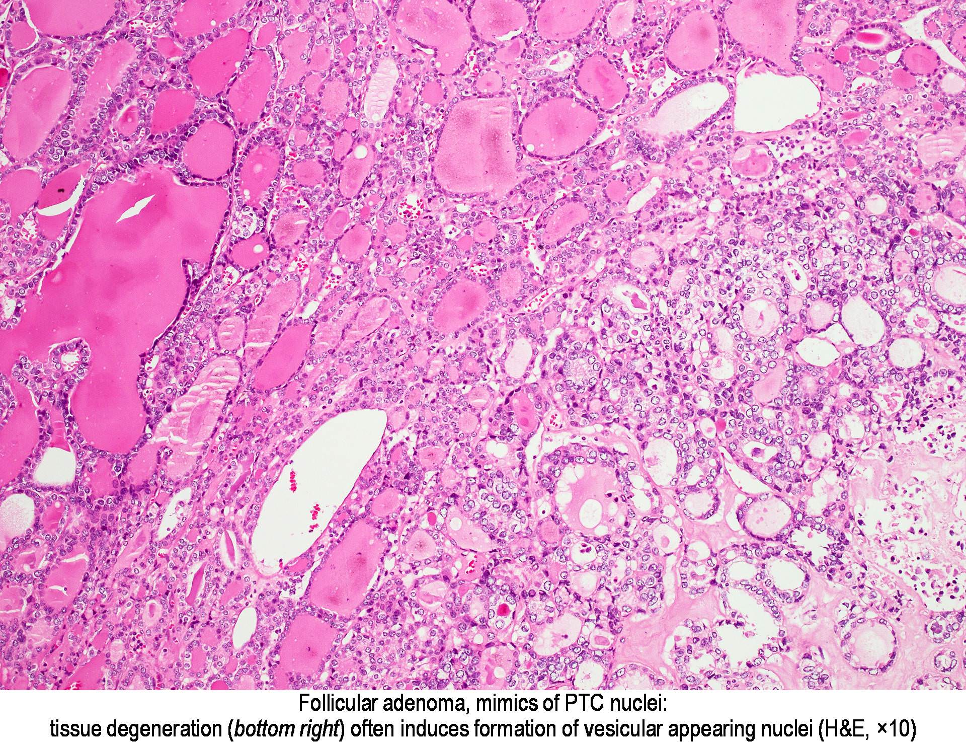 Pathology Outlines - Follicular adenoma
