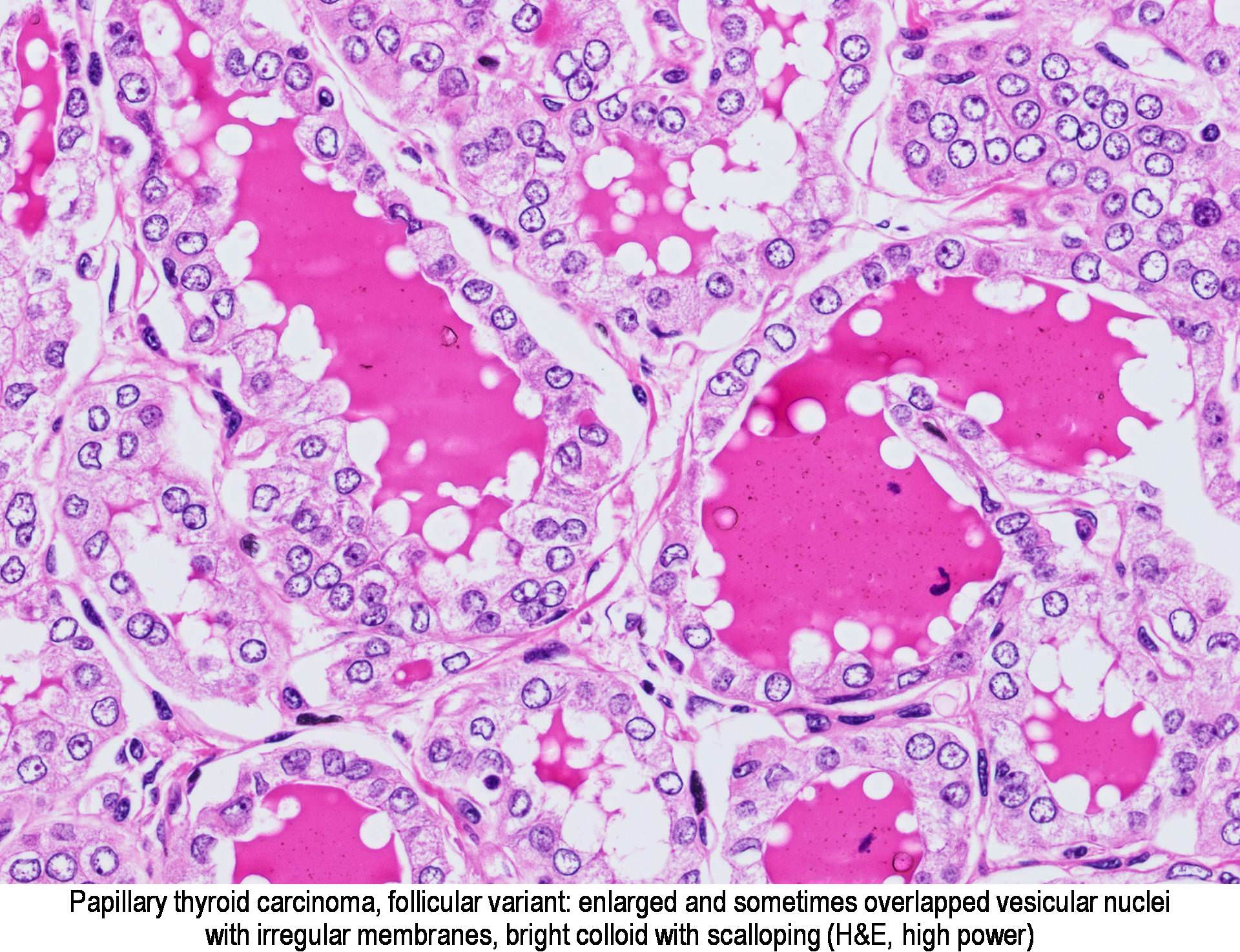 Pathology Outlines - Papillary carcinoma - follicular variant

