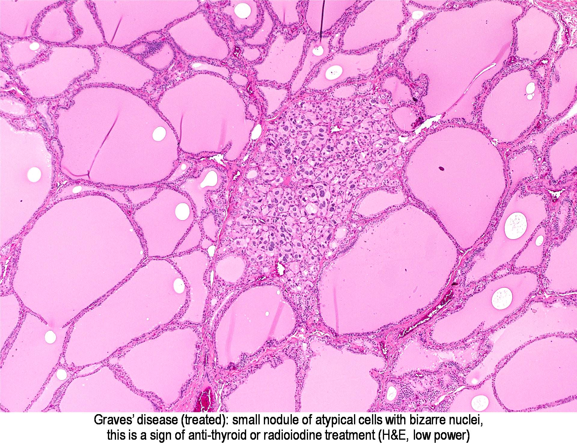 Pathology Outlines - Graves disease