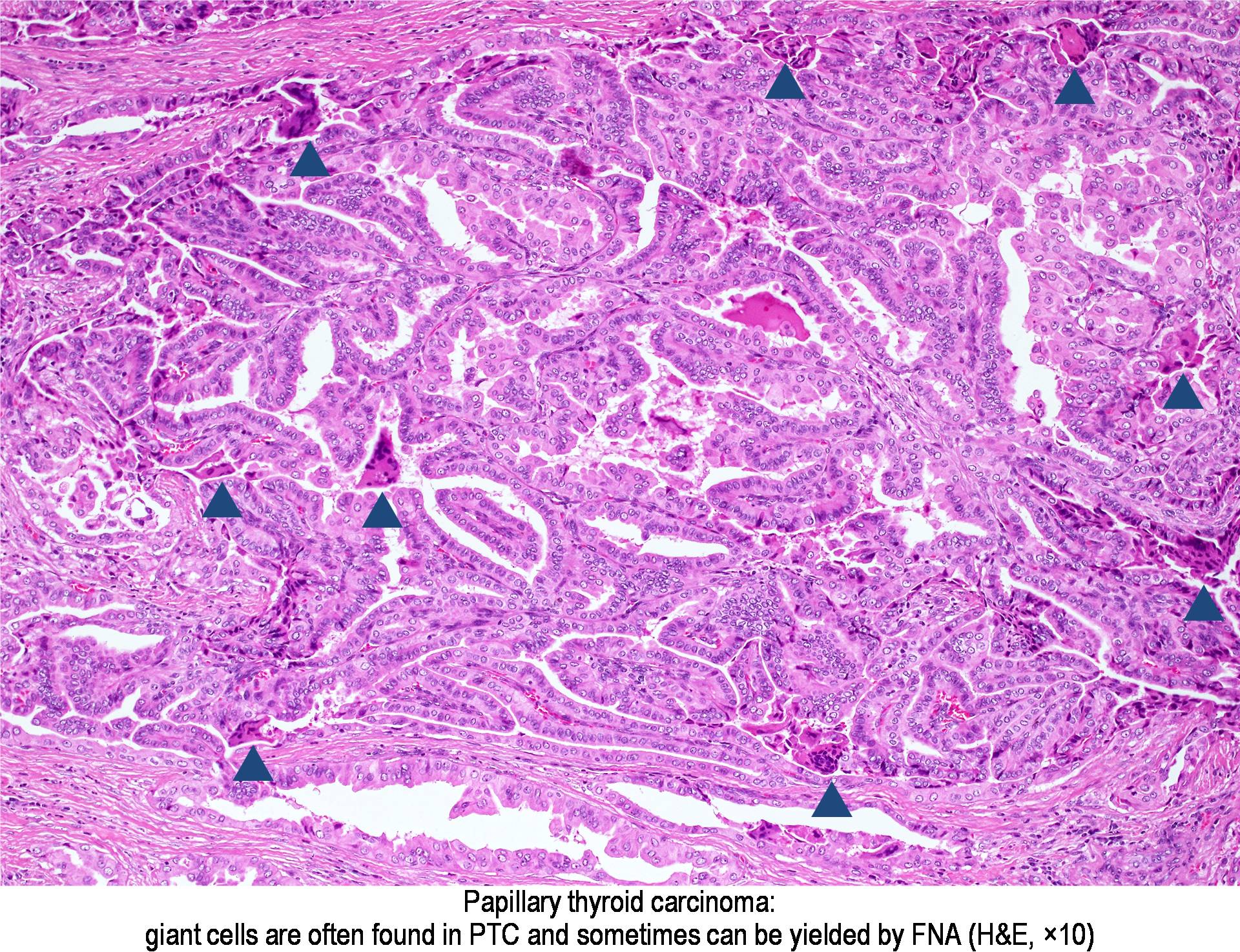 Thyroid Papillary Carcinoma Pathology Outlines