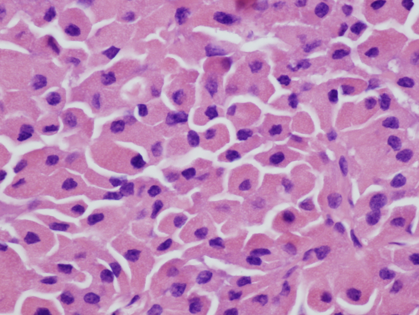 Pathology Outlines - Oncocytic (Hürthle cell) tumors
