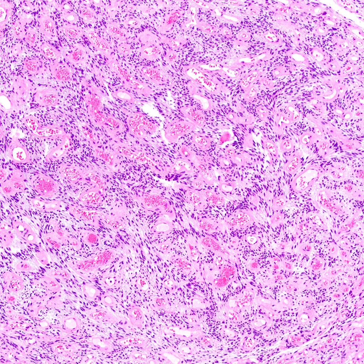 Pathology Outlines Cellular Angiofibroma