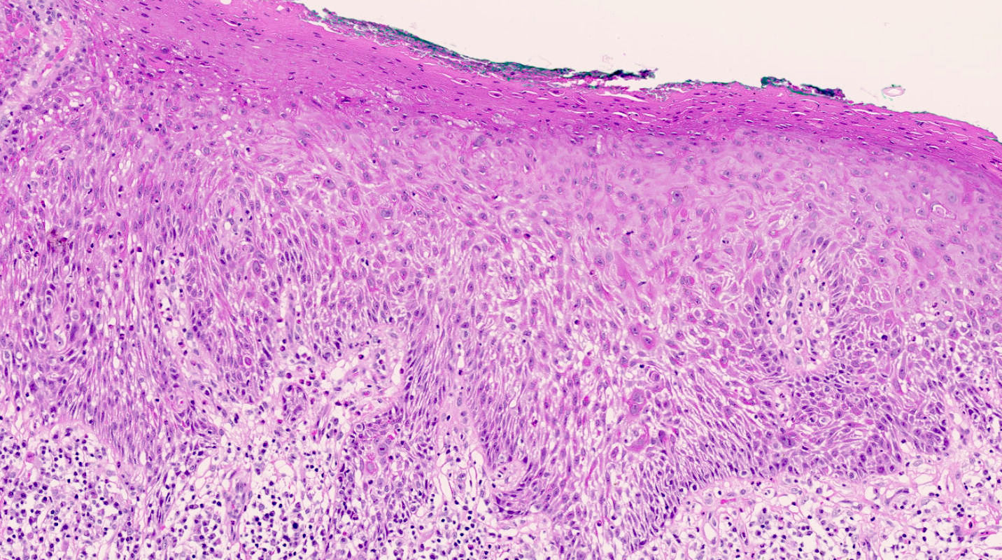 Pathology Outlines HPV independent VINvulva