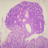 Qiaos Pathology: Tubular Adenoma of Duodenum (乔氏病理学：十二指肠管 
