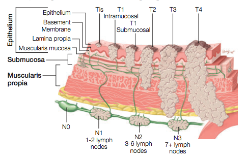 Esophageal Cancer Staging Chart