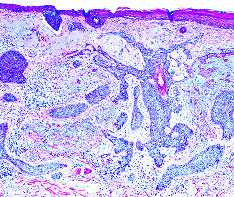 Pathology Outlines Basal Cell Carcinoma