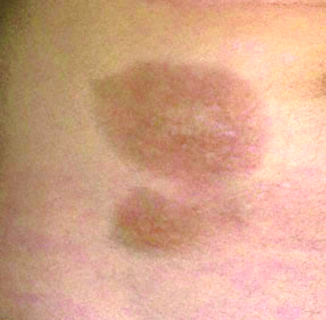 Morphea - Cleaver Dermatology