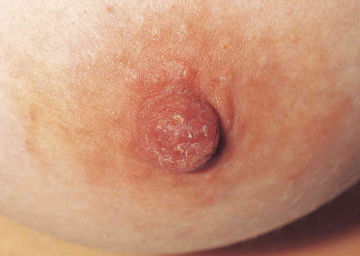 disease breast to pagets compare normal