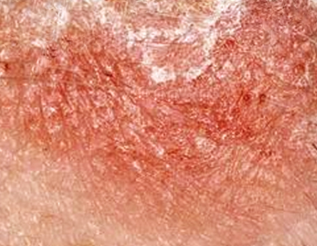 Spongiotic Dermatitis | Natural Health Magazine
