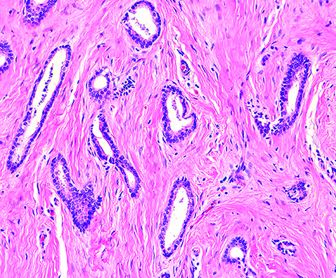 Pathology Outlines - Tubular