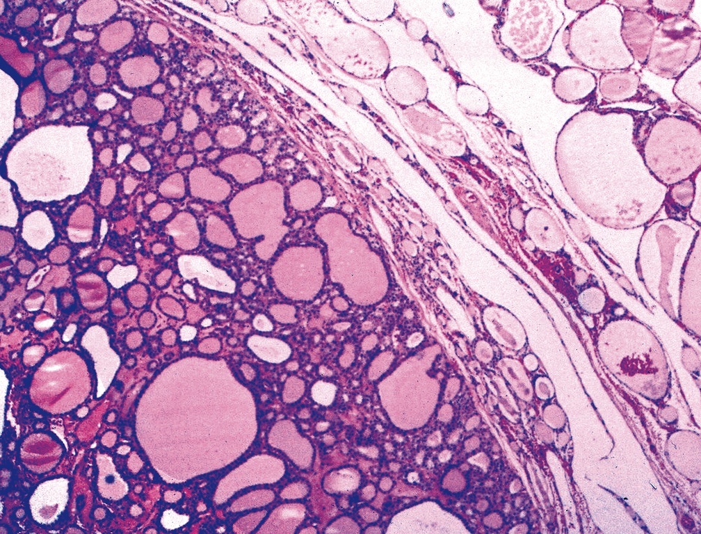 Pathology Outlines - Follicular adenoma

