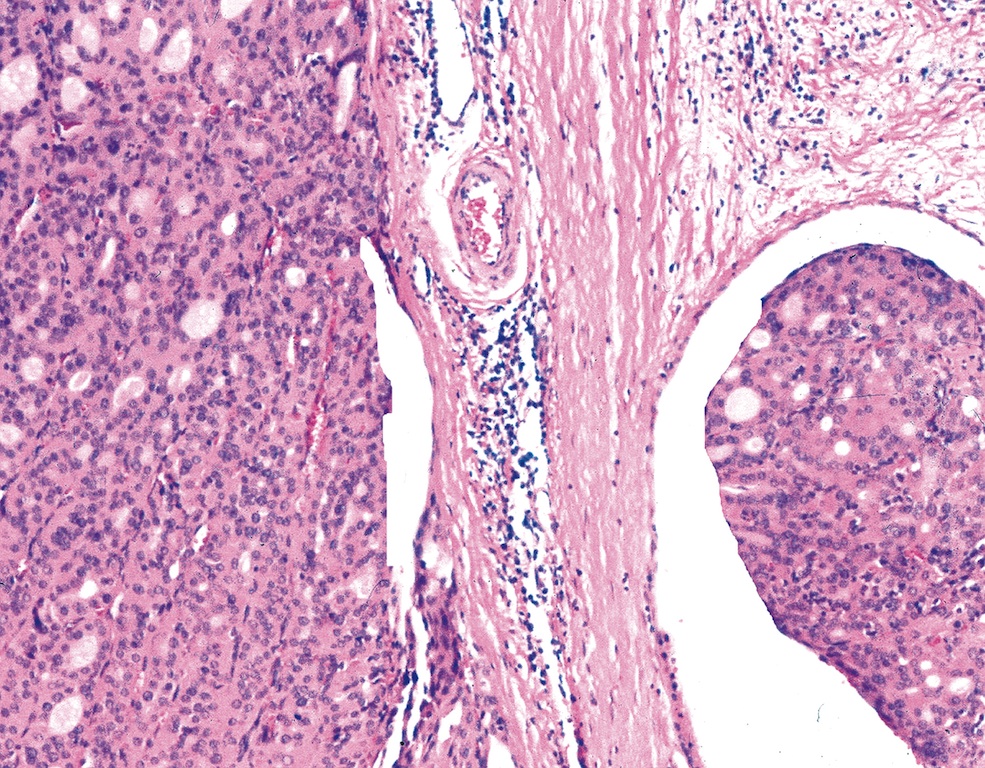Minimally invasive thyroid cancer